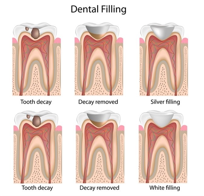 Dental Filling in Melbourne