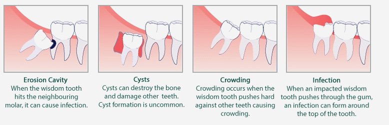 Tooth Extraction in Melbourne