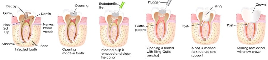 Root Canal Guide On Root Canal Treatment Prices Procedure Photos