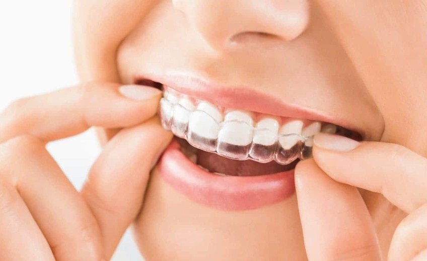 Clear Aligners Melbourne